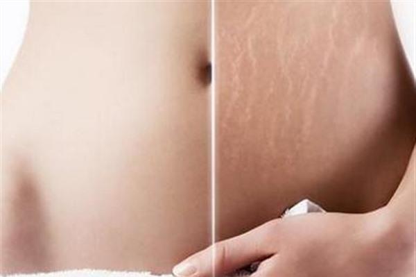 做腹壁整形<a href=http://m.f3bb6.cn/listinfo-791-0.html target=_blank class=infotextkey>去妊娠紋</a>有副作用嗎