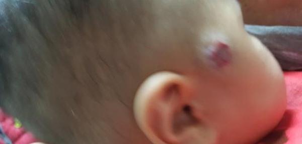 做激光<a href=http://m.f3bb6.cn/listinfo-777-0.html target=_blank class=infotextkey>治療血管瘤</a>要花多長(zhǎng)時(shí)間