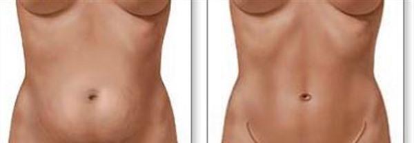 腹壁整形<a href=http://m.f3bb6.cn/listinfo-791-0.html target=_blank class=infotextkey>去妊娠紋</a>適應(yīng)癥狀是什么?