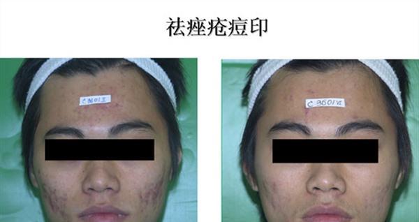 紅藍光祛痘麻醉方式是什么？