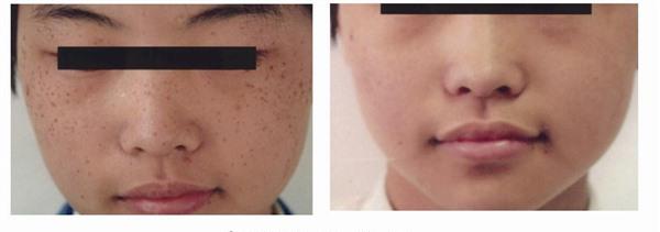 冷凍法<a href=http://m.f3bb6.cn/listinfo-774-0.html target=_blank class=infotextkey>去雀斑</a>麻醉方式是什么？