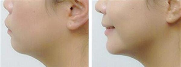 自體脂肪除頸紋適應(yīng)癥狀是什么?