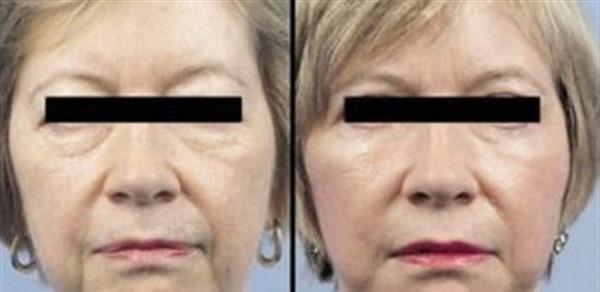 做<a href=http://m.f3bb6.cn/listinfo-613-0.html target=_blank class=infotextkey>射頻</a><a href=http://m.f3bb6.cn/listinfo-768-0.html target=_blank class=infotextkey>微針</a><a href=http://m.f3bb6.cn/listinfo-771-0.html target=_blank class=infotextkey>去眉間紋</a>風險有哪些