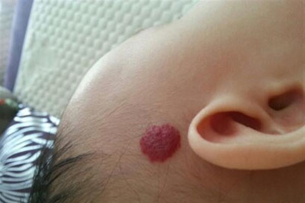 做激光<a href=http://m.f3bb6.cn/listinfo-777-0.html target=_blank class=infotextkey>治療血管瘤</a>效果好不好