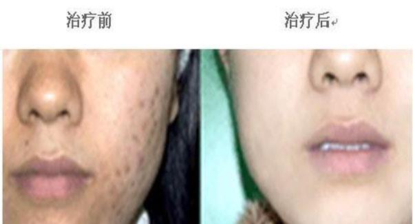 做冷凍治療<a href=http://m.f3bb6.cn/listinfo-797-0.html target=_blank class=infotextkey>去痘疤</a>副作用