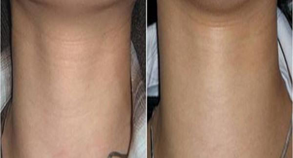 做<a href=http://m.f3bb6.cn/listinfo-731-0.html target=_blank class=infotextkey>玻尿酸</a>除頸紋手術時間是多久？