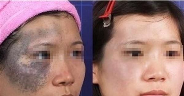 激光<a href=http://m.f3bb6.cn/listinfo-799-0.html target=_blank class=infotextkey>去太田痣</a>手術缺點有哪些？