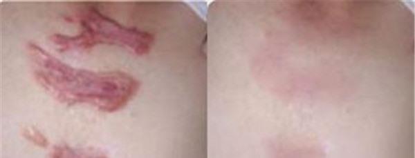 做燙傷疤痕修復(fù)價格大概需要多少