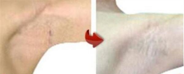 做激光<a href=http://m.f3bb6.cn/listinfo-766-0.html target=_blank class=infotextkey>去腋臭</a>價格多少錢