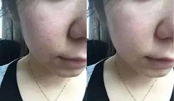 E光<a href=http://m.f3bb6.cn/listinfo-770-0.html target=_blank class=infotextkey>嫩膚</a>什么年齡適合做?