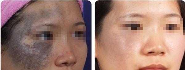 做皮膚磨削治太田痣價格