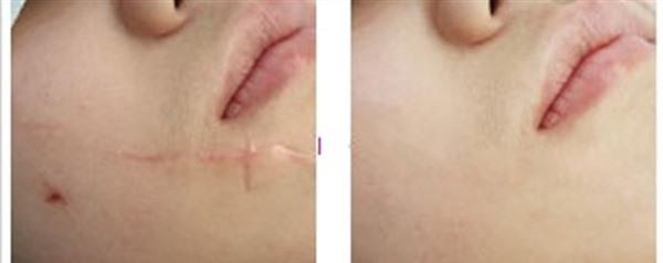 燙傷疤痕修復有哪些優點？