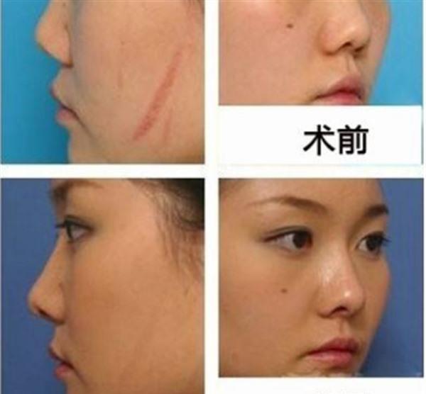 疤痕增生修復效果好不好？