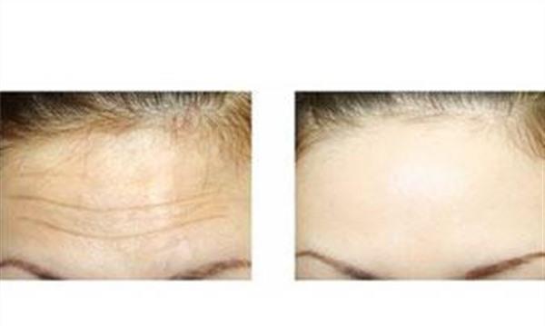 內(nèi)窺鏡<a href=http://m.f3bb6.cn/listinfo-614-0.html target=_blank class=infotextkey>除皺</a><a href=http://m.f3bb6.cn/listinfo-765-0.html target=_blank class=infotextkey>去抬頭紋</a>需要怎么護理？