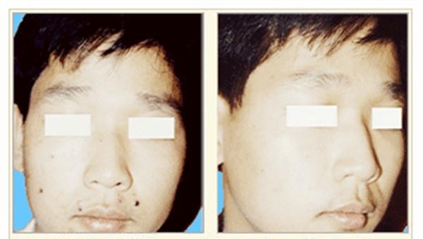 做激光點(diǎn)黑痣多少錢