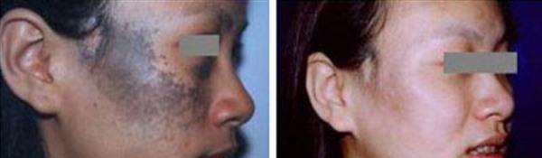 做皮膚磨削治太田痣手術(shù)多少錢？