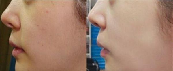 水光娃娃手術(shù)注意事項(xiàng)是什么？