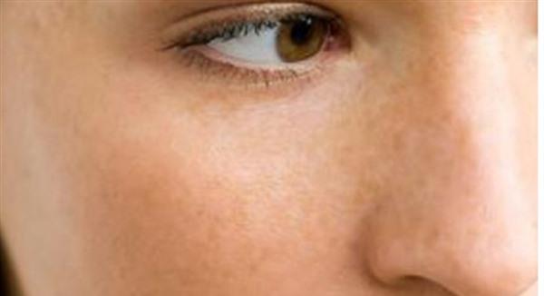 遺傳雀斑怎樣淡化