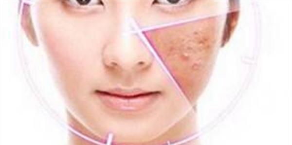 南京激光去痘印要多少錢