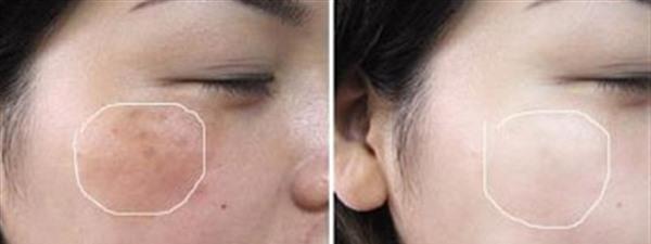 <a href=http://m.f3bb6.cn/listinfo-795-0.html target=_blank class=infotextkey>祛斑</a>方法哪種見效快