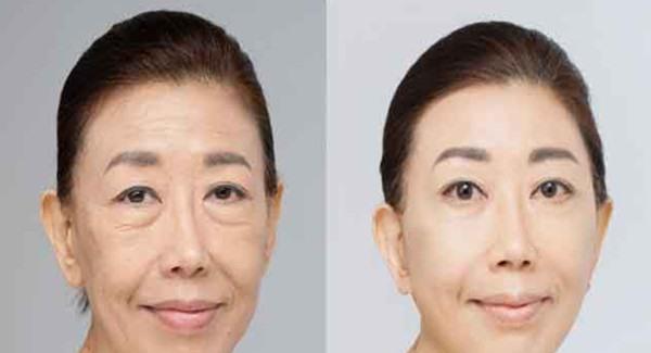 做激光<a href=http://m.f3bb6.cn/listinfo-792-0.html target=_blank class=infotextkey>去法令紋</a>有副作用嗎