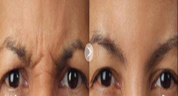 做<a href=http://m.f3bb6.cn/listinfo-734-0.html target=_blank class=infotextkey>愛貝芙</a><a href=http://m.f3bb6.cn/listinfo-771-0.html target=_blank class=infotextkey>去眉間紋</a>副作用