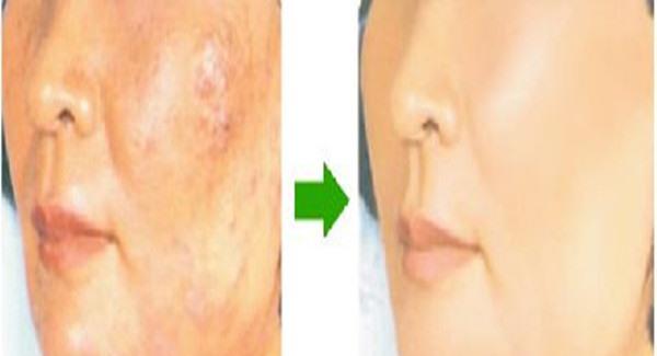 做激光去痘印手術時間是多久？