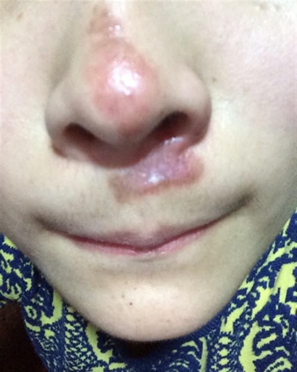 做疤痕增生修復效果好不好