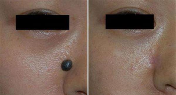 做手術去痣副作用是什么