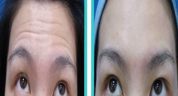 做<a href=http://m.f3bb6.cn/listinfo-765-0.html target=_blank class=infotextkey>去抬頭紋</a>失敗修復手術時間是多久？