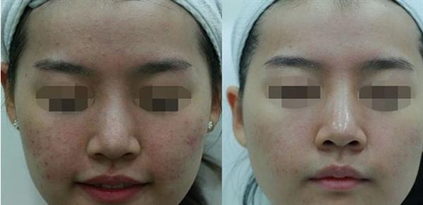 鐳射凈膚有副作用嗎？