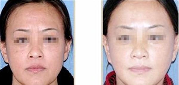 <a href=http://m.f3bb6.cn/listinfo-613-0.html target=_blank class=infotextkey>射頻</a><a href=http://m.f3bb6.cn/listinfo-768-0.html target=_blank class=infotextkey>微針</a><a href=http://m.f3bb6.cn/listinfo-771-0.html target=_blank class=infotextkey>去眉間紋</a>有副作用嗎？