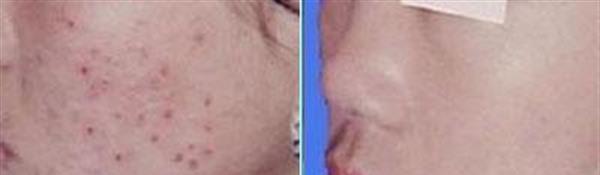 切除縫合治療痘疤手術安全嗎？