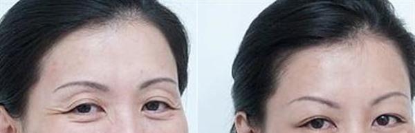 微晶磨皮<a href=http://m.f3bb6.cn/listinfo-780-0.html target=_blank class=infotextkey>去魚尾紋</a>手術注意事項是什么?