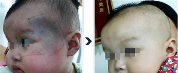 冷凍去除太田痣手術(shù)術(shù)后護理？