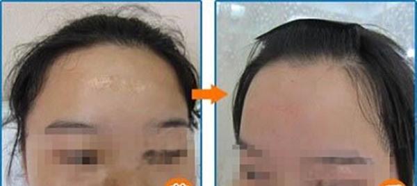 比較成熟的像素激光技術(shù)治療范圍有哪些