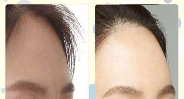 冷凍治療<a href=http://m.f3bb6.cn/listinfo-797-0.html target=_blank class=infotextkey>去痘疤</a>價格