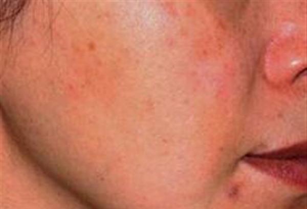 <a href=http://m.f3bb6.cn/listinfo-731-0.html target=_blank class=infotextkey>玻尿酸</a><a href=http://m.f3bb6.cn/listinfo-797-0.html target=_blank class=infotextkey>去痘疤</a>多少錢