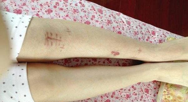 去疤痕手術(shù)的費(fèi)用