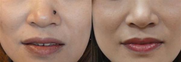 怎么<a href=http://m.f3bb6.cn/listinfo-767-0.html target=_blank class=infotextkey>祛痣</a>安全 <a href=http://m.f3bb6.cn/listinfo-767-0.html target=_blank class=infotextkey>祛痣</a>的安全方法