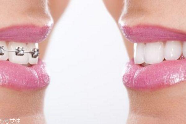 <a href=http://m.f3bb6.cn/listinfo-830-0.html target=_blank class=infotextkey>美容冠</a>矯正牙齒好不好 <a href=http://m.f3bb6.cn/listinfo-830-0.html target=_blank class=infotextkey>美容冠</a>矯正牙齒好處和壞處
