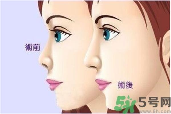 <a href=http://m.f3bb6.cn/listinfo-731-0.html target=_blank class=infotextkey>玻尿酸</a><a href=http://m.f3bb6.cn/listinfo-737-0.html target=_blank class=infotextkey>隆鼻</a>的缺點是什么?<a href=http://m.f3bb6.cn/listinfo-731-0.html target=_blank class=infotextkey>玻尿酸</a><a href=http://m.f3bb6.cn/listinfo-737-0.html target=_blank class=infotextkey>隆鼻</a>的優點有哪些?