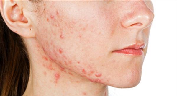 祛痘手術(shù)時間需要多久？