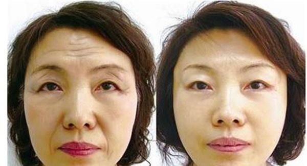 做光子除抬頭紋副作用