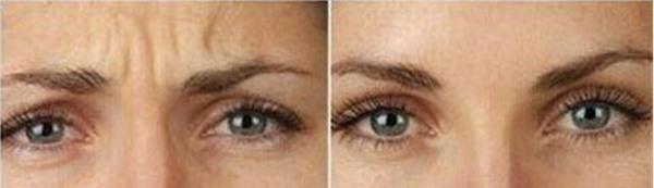 <a href=http://m.f3bb6.cn/listinfo-613-0.html target=_blank class=infotextkey>射頻</a><a href=http://m.f3bb6.cn/listinfo-768-0.html target=_blank class=infotextkey>微針</a><a href=http://m.f3bb6.cn/listinfo-771-0.html target=_blank class=infotextkey>去眉間紋</a>手術的方法是什么?