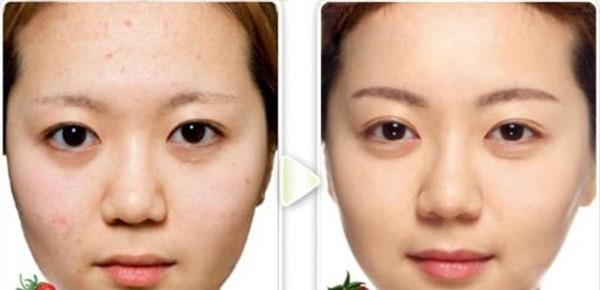 果酸煥膚<a href=http://m.f3bb6.cn/listinfo-781-0.html target=_blank class=infotextkey>祛痘印</a>手術的方法是什么?