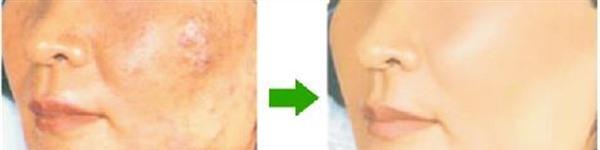 激光去痘印手術的方法是什么？