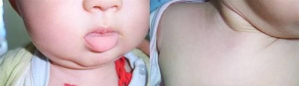 做<a href=http://m.f3bb6.cn/listinfo-777-0.html target=_blank class=infotextkey>治療血管瘤</a>護理方法