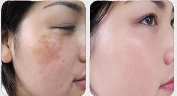 做<a href=http://m.f3bb6.cn/listinfo-613-0.html target=_blank class=infotextkey>射頻</a><a href=http://m.f3bb6.cn/listinfo-795-0.html target=_blank class=infotextkey>祛斑</a>價格大概需要多少