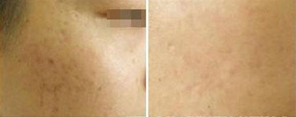 做微晶磨削<a href=http://m.f3bb6.cn/listinfo-774-0.html target=_blank class=infotextkey>去雀斑</a>價(jià)格大概需要多少